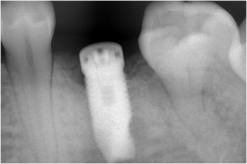 阿久井6　埋入後約3ヶ月